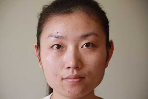 去除痘印的12個(gè)小偏方 去除痘印的12個(gè)小偏方