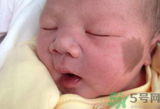 寶寶身上有胎記長(zhǎng)大后會(huì)消失嗎.png 寶寶身上有胎記長(zhǎng)大后會(huì)消失嗎.png