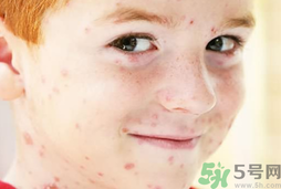 孩子得了水痘全身很癢怎么辦?緩解水痘瘙癢妙招.png 孩子得了水痘全身很癢怎么辦?緩解水痘瘙癢妙招.png