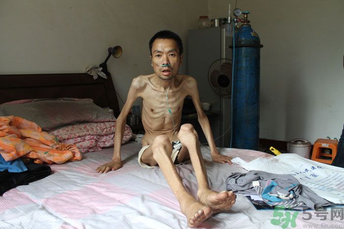 器官衰竭的癥狀有哪些?器官衰竭能恢復(fù)嗎 器官衰竭的癥狀有哪些?器官衰竭能恢復(fù)嗎