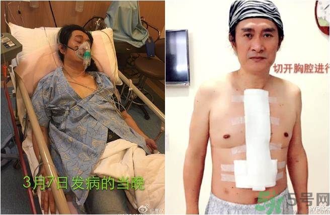 黃安重金求診歐氏管開放癥,歐式管開放癥是什么病癥? 黃安重金求診歐氏管開放癥,歐式管開放癥是什么病癥?