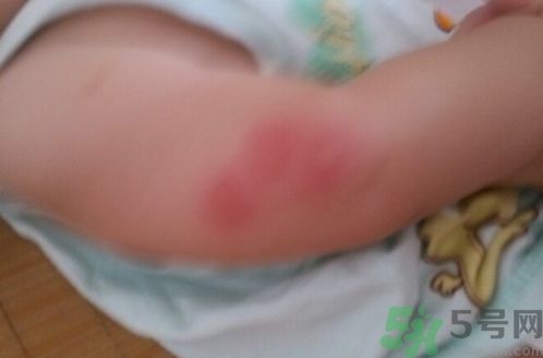 寶寶被蚊子咬了涂什么藥膏安全又有效? 寶寶被蚊子咬了涂什么藥膏安全又有效?
