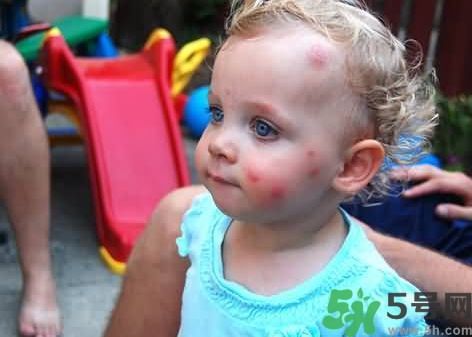 寶寶被蚊子咬了怎么快速止癢消腫? 寶寶被蚊子咬了怎么快速止癢消腫?