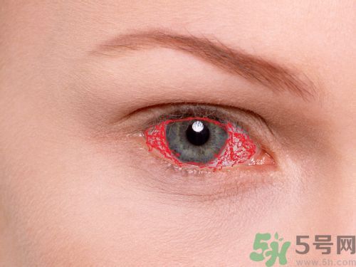 汪涵錄節(jié)目眼球血管破裂,眼球血管破裂是怎么回事 汪涵錄節(jié)目眼球血管破裂,眼球血管破裂是怎么回事