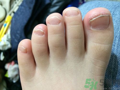 灰指甲的危害有哪些?灰指甲的初期癥狀是什么 灰指甲的危害有哪些?灰指甲的初期癥狀是什么