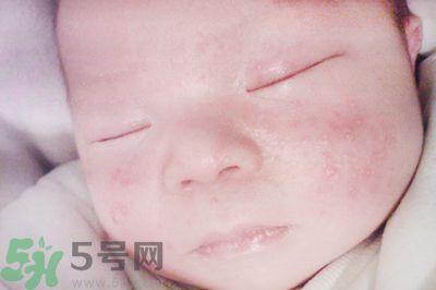 云南白藥可以治濕疹嗎?云南白藥能治濕疹嗎? 云南白藥可以治濕疹嗎?云南白藥能治濕疹嗎?