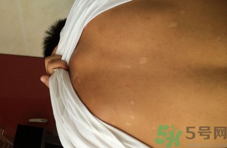 花露水可以治汗斑嗎?花露水能根治汗斑嗎? 花露水可以治汗斑嗎?花露水能根治汗斑嗎?