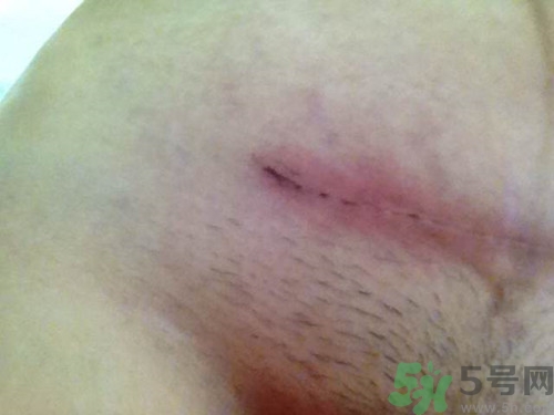 側(cè)切傷口多久能好?產(chǎn)后側(cè)切傷口如何護(hù)理 側(cè)切傷口多久能好?產(chǎn)后側(cè)切傷口如何護(hù)理