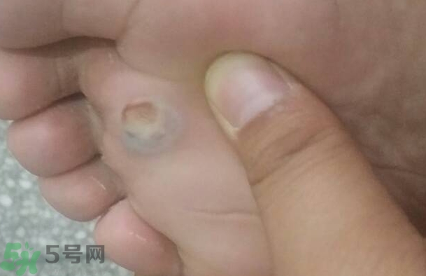 夏天腳脫皮起泡是怎么回事?夏天腳脫皮起泡怎么辦? 夏天腳脫皮起泡是怎么回事?夏天腳脫皮起泡怎么辦?