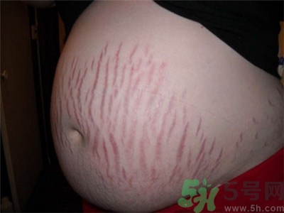 生完孩子后肚子上的黑線怎么辦?生完孩子后肚子上的黑線多久消失 生完孩子后肚子上的黑線怎么辦?生完孩子后肚子上的黑線多久消失