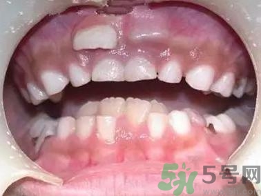 雙排牙是什么?雙排牙的危害 雙排牙是什么?雙排牙的危害