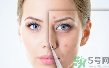 雞蛋清可以去痘痘嗎?雞蛋清能去痘痘嗎? 雞蛋清可以去痘痘嗎?雞蛋清能去痘痘嗎?