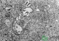 裂谷熱病怎么治？裂谷熱病的癥狀有哪些？