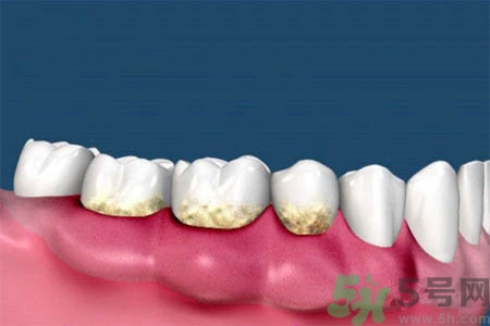 哪些人不能洗牙？洗牙需要注意什么？