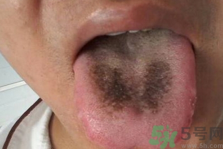 舌頭發(fā)黑怎么回事？舌頭發(fā)黑怎么辦？