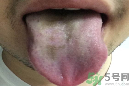 舌頭發(fā)黑怎么回事？舌頭發(fā)黑怎么辦？
