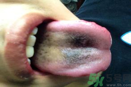 舌頭發(fā)黑怎么回事？舌頭發(fā)黑怎么辦？