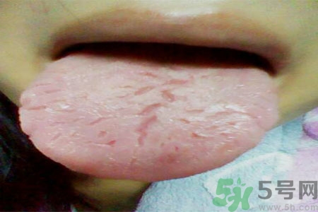 舌頭上有裂紋是怎么辦？舌頭上有裂紋是什么原因？
