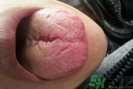 舌頭上有裂紋是怎么辦？舌頭上有裂紋是什么原因？