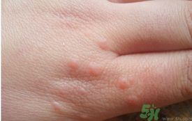 手上長小疙瘩很癢怎么回事?手上長小疙瘩怎么辦 手上長小疙瘩很癢怎么回事?手上長小疙瘩怎么辦