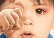 寶寶得了紅眼病怎么辦？寶寶得了紅眼病怎么治？