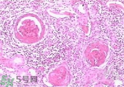 慢性腎炎能治好嗎？慢性腎炎能活多久？