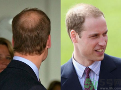 男人禿頂是什么原因？男人禿頂怎么辦？