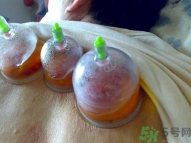 拔火罐后可以洗澡嗎?拔火罐后能洗澡嗎? 拔火罐后可以洗澡嗎?拔火罐后能洗澡嗎?