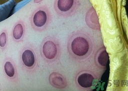 拔火罐后可以喝酒嗎?拔火罐后多久能喝酒? 拔火罐后可以喝酒嗎?拔火罐后多久能喝酒?