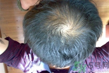 脫發(fā)的高發(fā)人群有哪些？如何預(yù)防脫發(fā)？