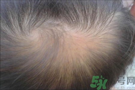 脫發(fā)的高發(fā)人群有哪些？如何預(yù)防脫發(fā)？