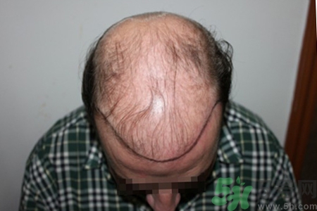 脫發(fā)會(huì)遺傳嗎？脫發(fā)遺傳可以治療嗎？