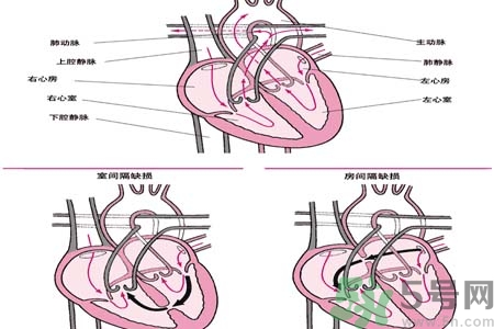 先天性心臟病是什么？先天性心臟病的癥狀有哪些？