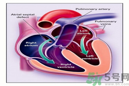 先天性心臟病發(fā)病原因是什么？