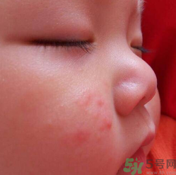 寶寶長蘚是怎么回事？寶寶長蘚怎么辦？