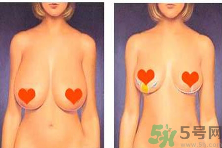 ?女性乳房下垂的原因是什么？女性乳房下垂的分類(lèi)有哪些？