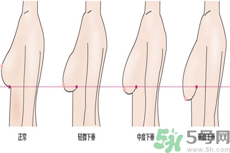 ?女性乳房下垂的原因是什么？女性乳房下垂的分類(lèi)有哪些？