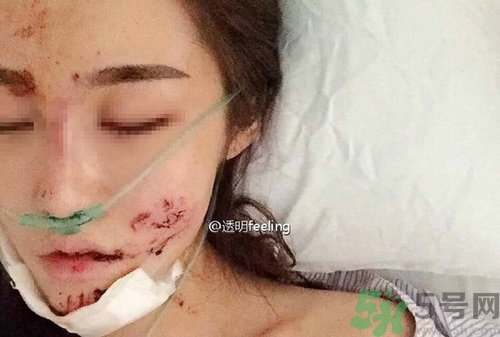 知名網(wǎng)紅被毀容是誰?車禍毀容的賠償標(biāo)準(zhǔn) 知名網(wǎng)紅被毀容是誰?車禍毀容的賠償標(biāo)準(zhǔn)