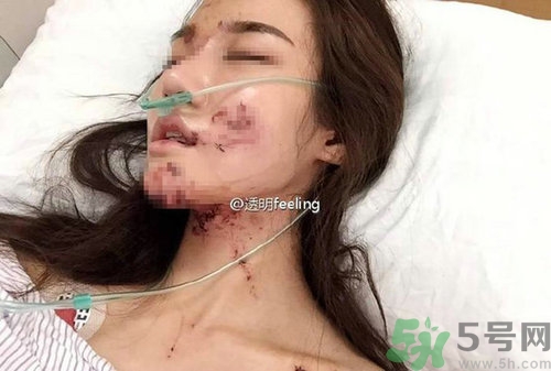 知名網(wǎng)紅被毀容是誰?車禍毀容的賠償標(biāo)準(zhǔn) 知名網(wǎng)紅被毀容是誰?車禍毀容的賠償標(biāo)準(zhǔn)