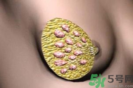 乳腺增生鈣化是什么？乳腺鈣化的癥狀有哪些？