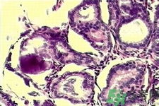 乳腺增生鈣化是什么？乳腺鈣化的癥狀有哪些？