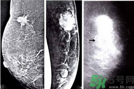 乳腺增生鈣化是什么？乳腺鈣化的癥狀有哪些？