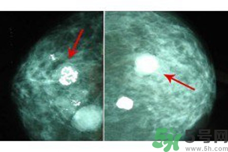 乳腺增生鈣化是什么？乳腺鈣化的癥狀有哪些？