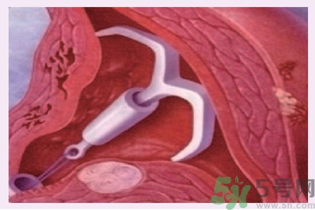 什么是宮內(nèi)節(jié)育器？放置宮內(nèi)節(jié)育器為什么能避孕？