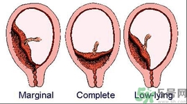 陰道出血是怎么回事？如何預(yù)防陰道出血？