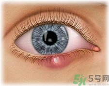 眼皮里長了個疙瘩是怎么回事?眼睛里長了個小白點怎么辦? 眼皮里長了個疙瘩是怎么回事?眼睛里長了個小白點怎么辦?