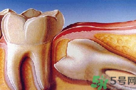 智齒橫著長怎么辦？智齒橫著長一定要拔了嗎？
