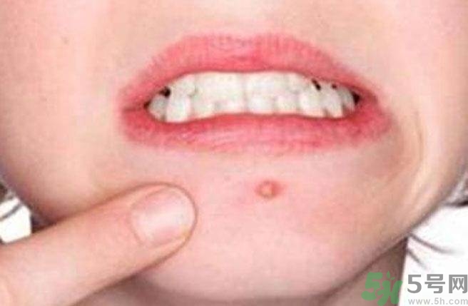 什么樣的痘痘能擠？哪些痘痘不能擠？