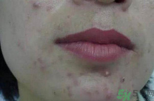 什么樣的痘痘能擠？哪些痘痘不能擠？