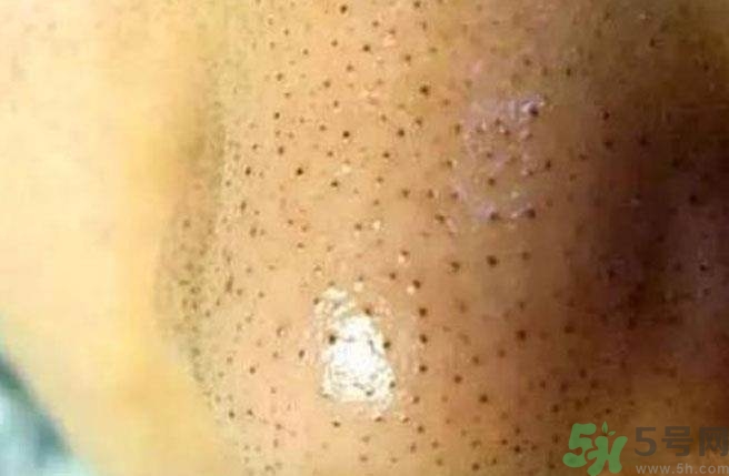 什么樣的痘痘能擠？哪些痘痘不能擠？